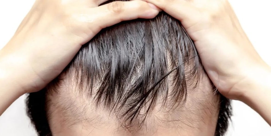 علاج تساقط الشعر وأسباب
